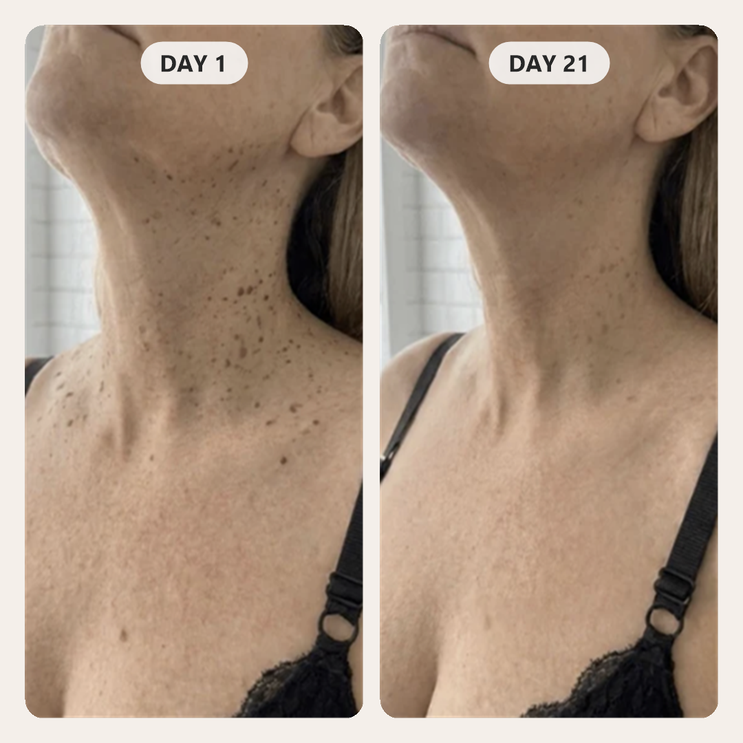 Customer's neck and chest on day 1 and day 21 of using Arcor